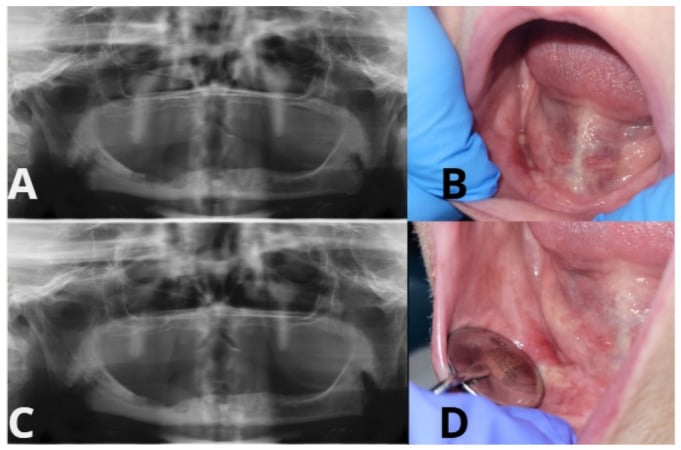 Panoramic radiograph and intraoral views of surgically managed osteonecrosis of the jaw