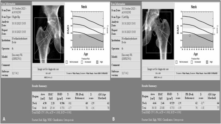 Dual-energy X-ray absorptiometry of both hips reporting Z-scores
