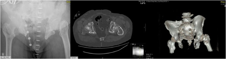 Femoral-neck fracture in an adult with congenital pubic diastasis on radiograph axial CT and three-dimensional CT