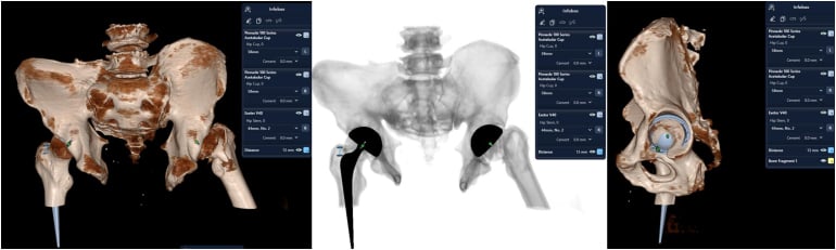 Three-dimensional planning for total hip arthroplasty in congenital pubic diastasis