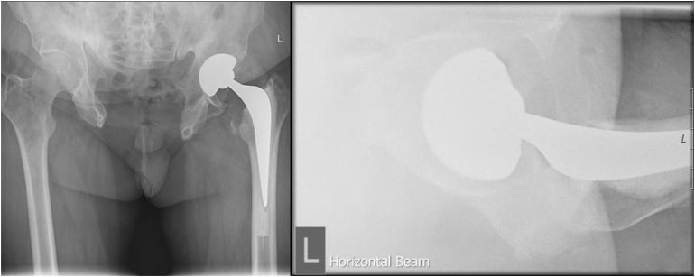 AP and cross-table lateral radiographs after total hip arthroplasty in congenital pubic diastasis