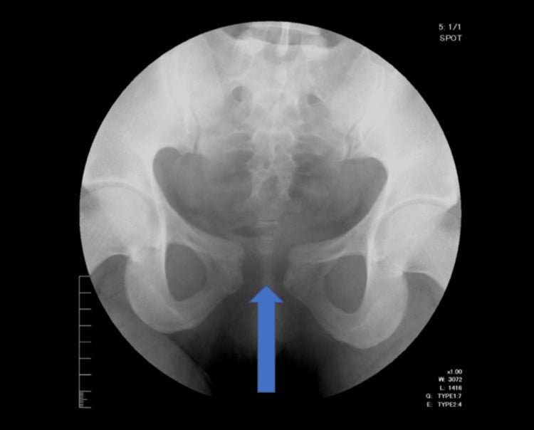 AP pelvis showing mild idiopathic pubic-symphysis diastasis