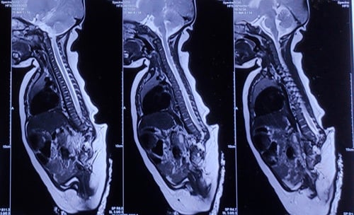 Sagittal MRI showing caudal spinal dysraphism with absent sacrum and terminal syrinx