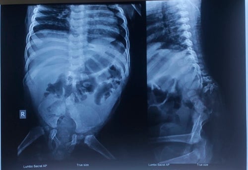 AP and lateral radiographs showing absent sacrum fused iliac bones and shifted lumbar spine