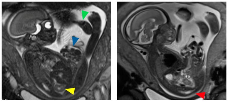 Fetal MRI showing multiple features of cloacal exstrophy