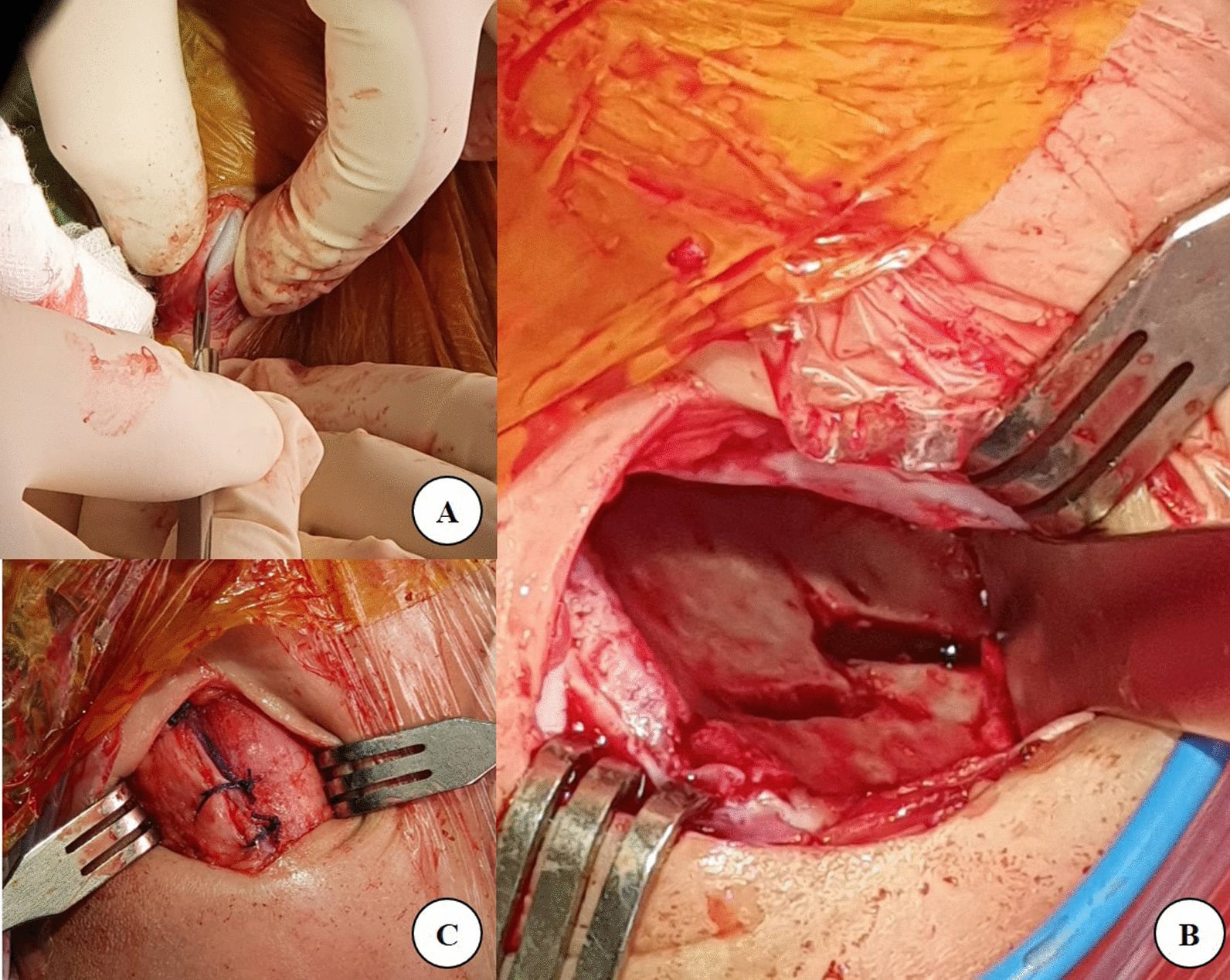 Operative exposure and execution of a bayonet iliac osteotomy