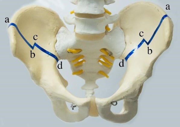 Sawbones model showing bilateral bayonet pelvic-osteotomy cuts