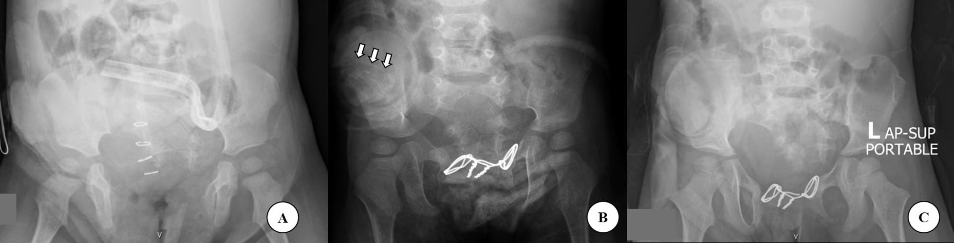 Preoperative postoperative and three-year radiographs after bayonet osteotomy and pubic approximation