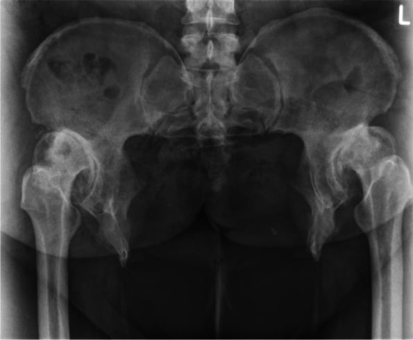 Adult pelvis with 18-centimetre congenital pubic diastasis and bilateral secondary hip osteoarthritis