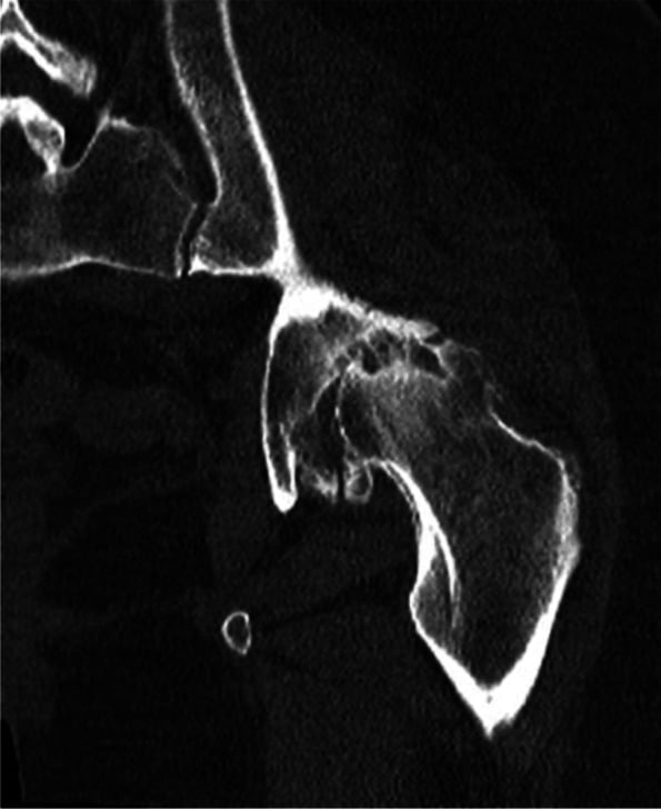 Coronal CT showing dysplastic arthritic hip morphology in congenital pubic diastasis