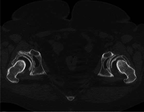 Axial CT showing acetabular retroversion and external rotation of the exstrophy pelvis