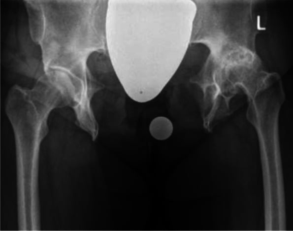 Adult pelvis with 14.6-centimetre pubic diastasis and severe asymmetric hip degeneration