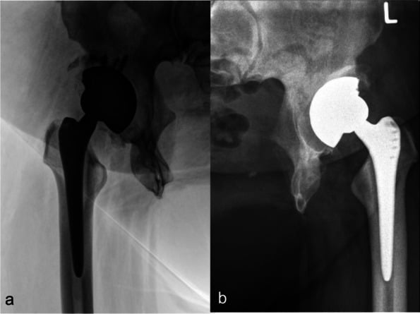 Bilateral total hip arthroplasty constructs adapted to congenital pubic diastasis