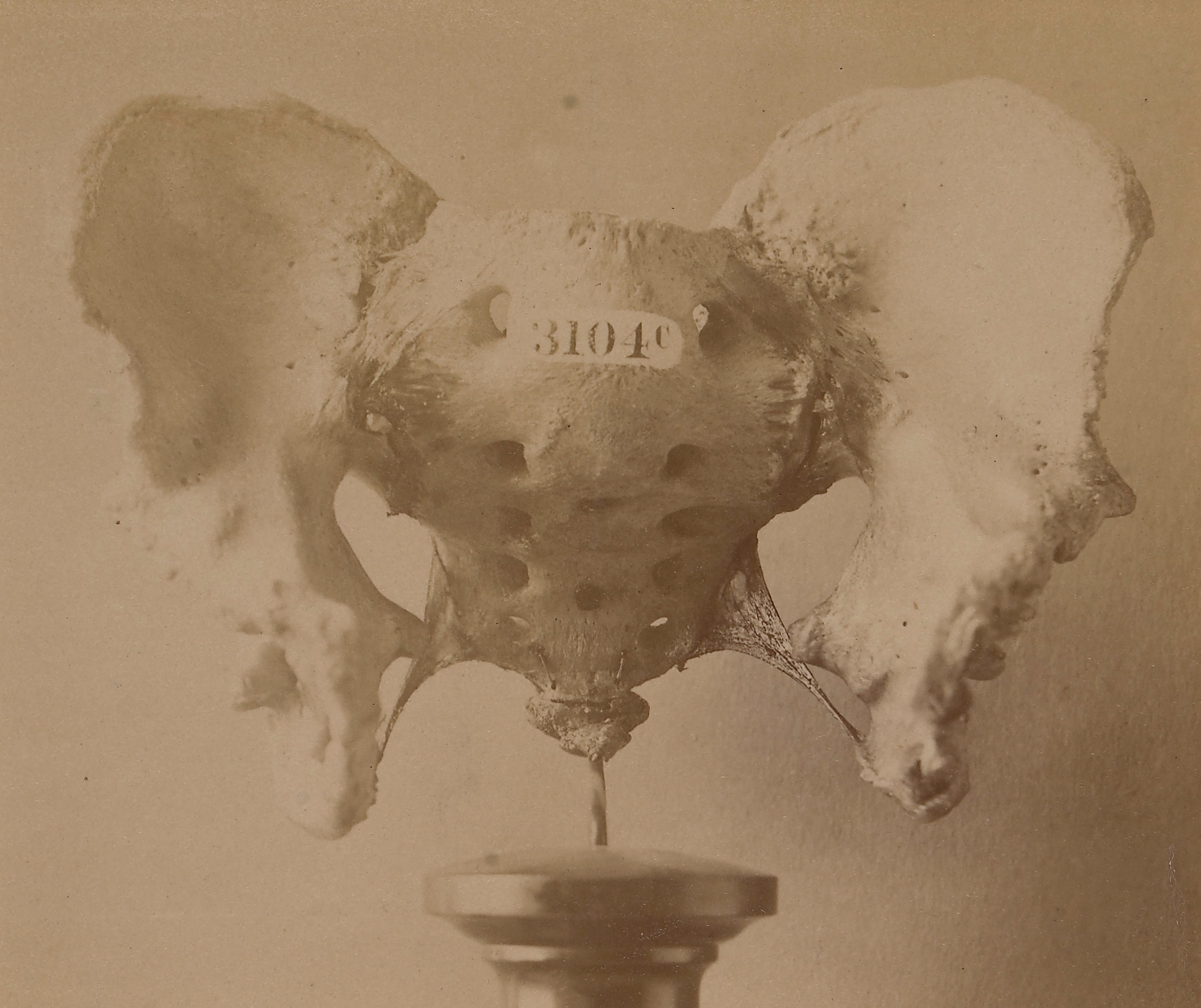 Dry adult pelvis specimen showing the characteristic exstrophy pelvic ring