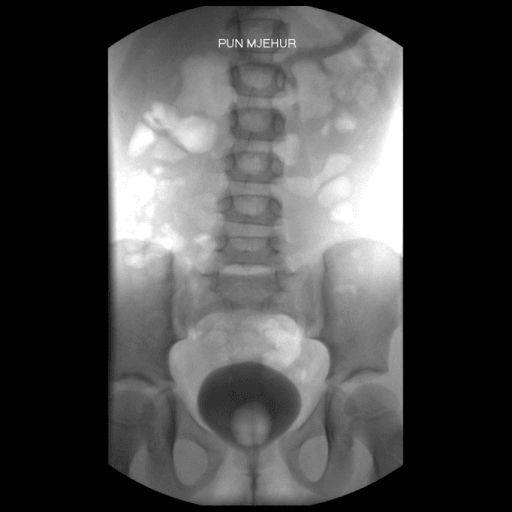 MCUG showing pubic diastasis in isolated epispadias
