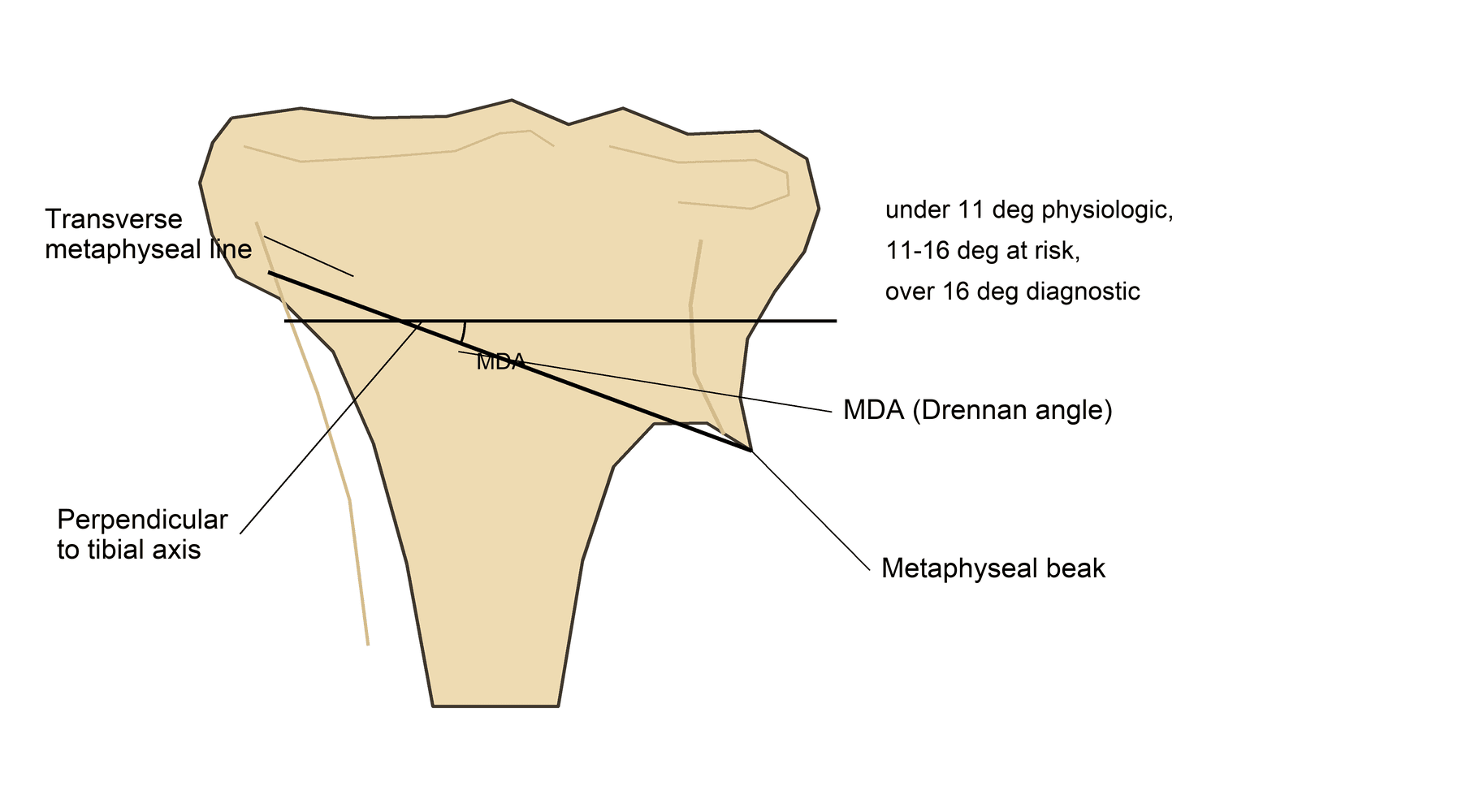Diagram of the metaphyseal-diaphyseal (Drennan) angle measurement on the proximal tibia in Blount disease