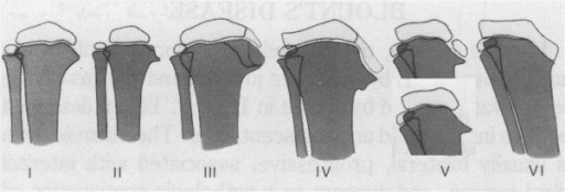 Langenskiöld classification stages I-VI for Blount disease