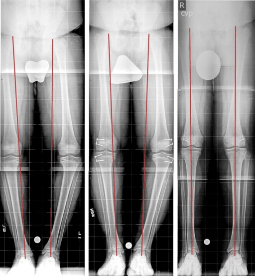 Guided growth treatment for bilateral Blount disease with long leg X-rays