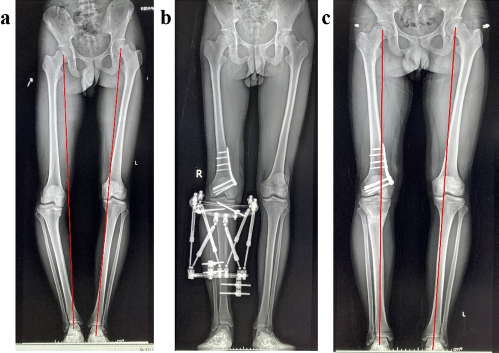 Adolescent Blount disease spatial-frame correction