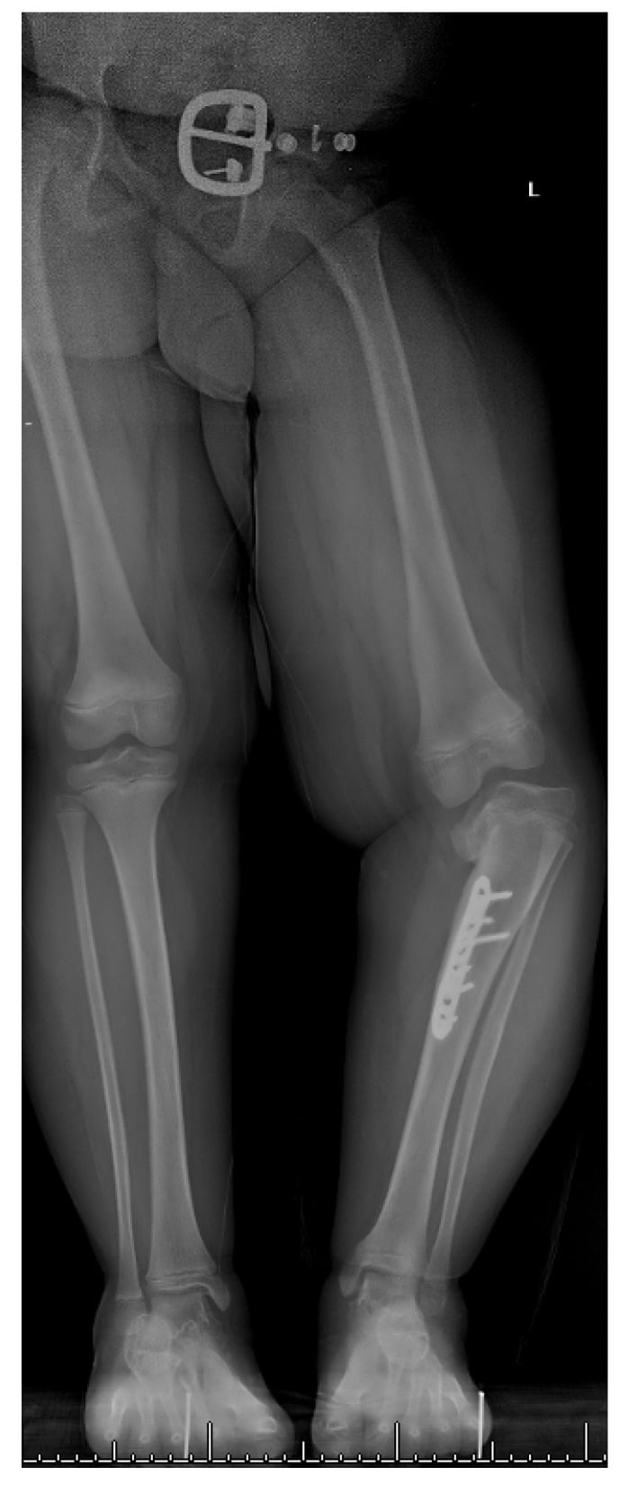 Recurrent deformity from medial physeal bar