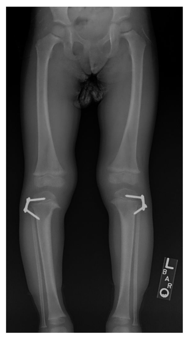 Interval correction after lateral hemi-epiphysiodesis