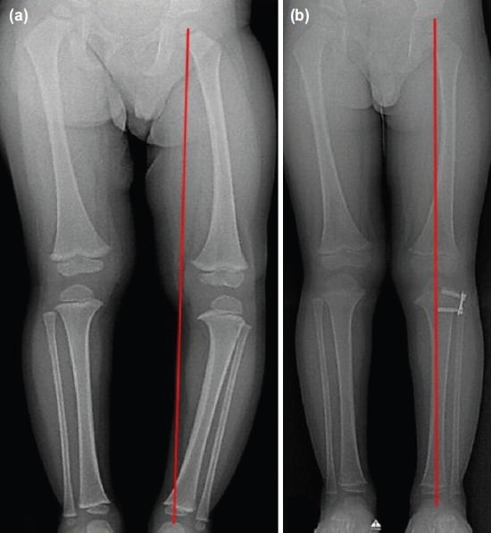 Guided-growth correction of mechanical axis