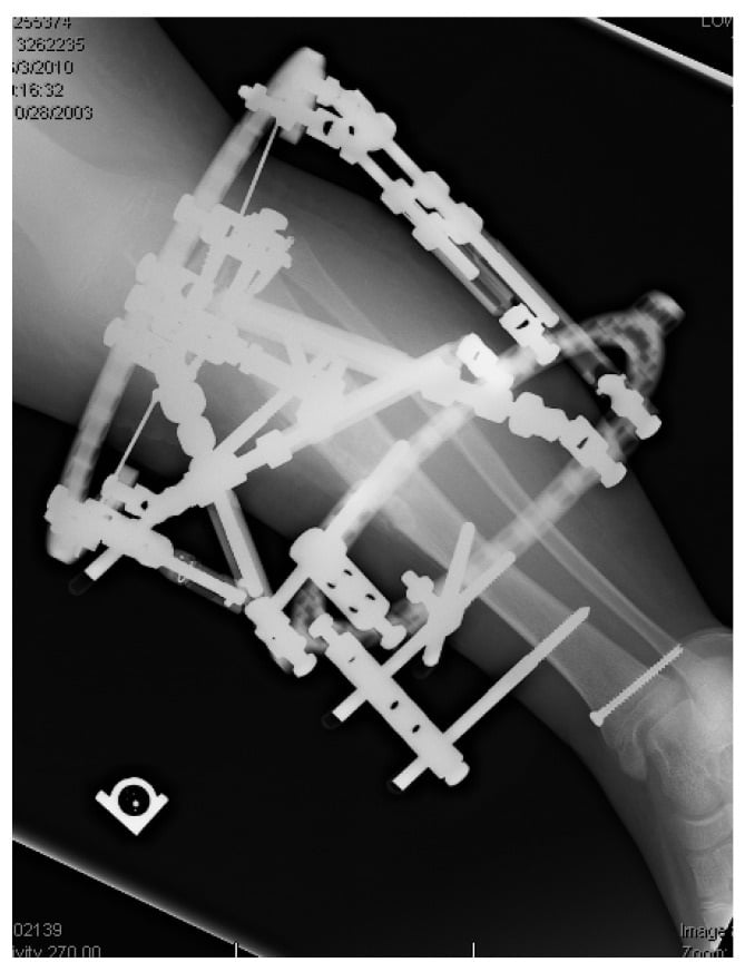 Hexapod correction of triplanar deformity