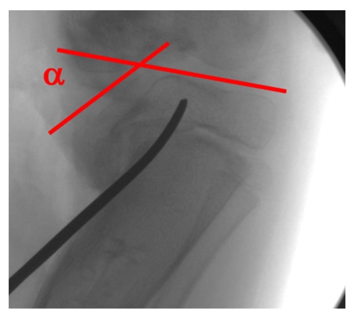 Medial tibial plateau depression angle