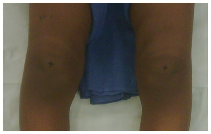 Positive cover-up test in infantile tibia vara