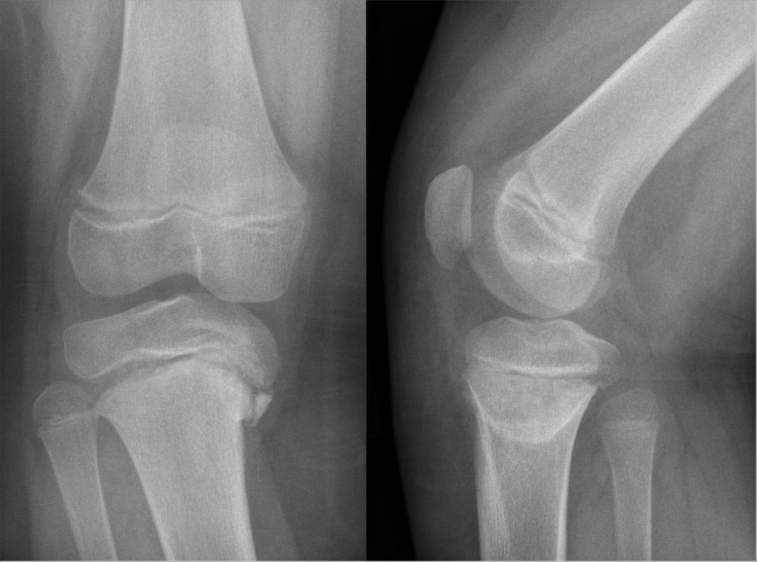 AP and lateral knee radiographs of Blount disease showing medial metaphyseal beaking.