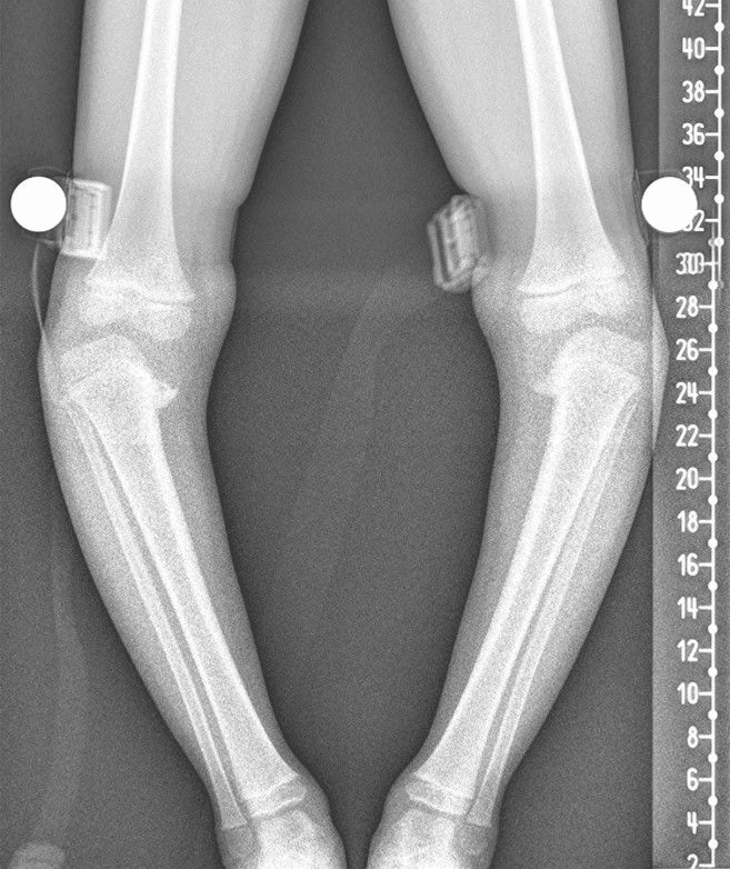 Standing AP leg radiograph: bilateral proximal tibial varus (tibia vara) of Blount disease with medial metaphyseal beaking; spheres are planning markers.