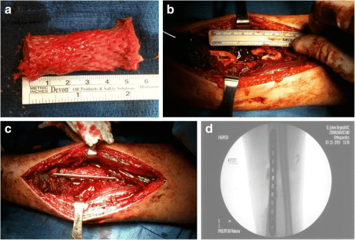Intercalary fascial autograft technique for critical bone defect reconstruction