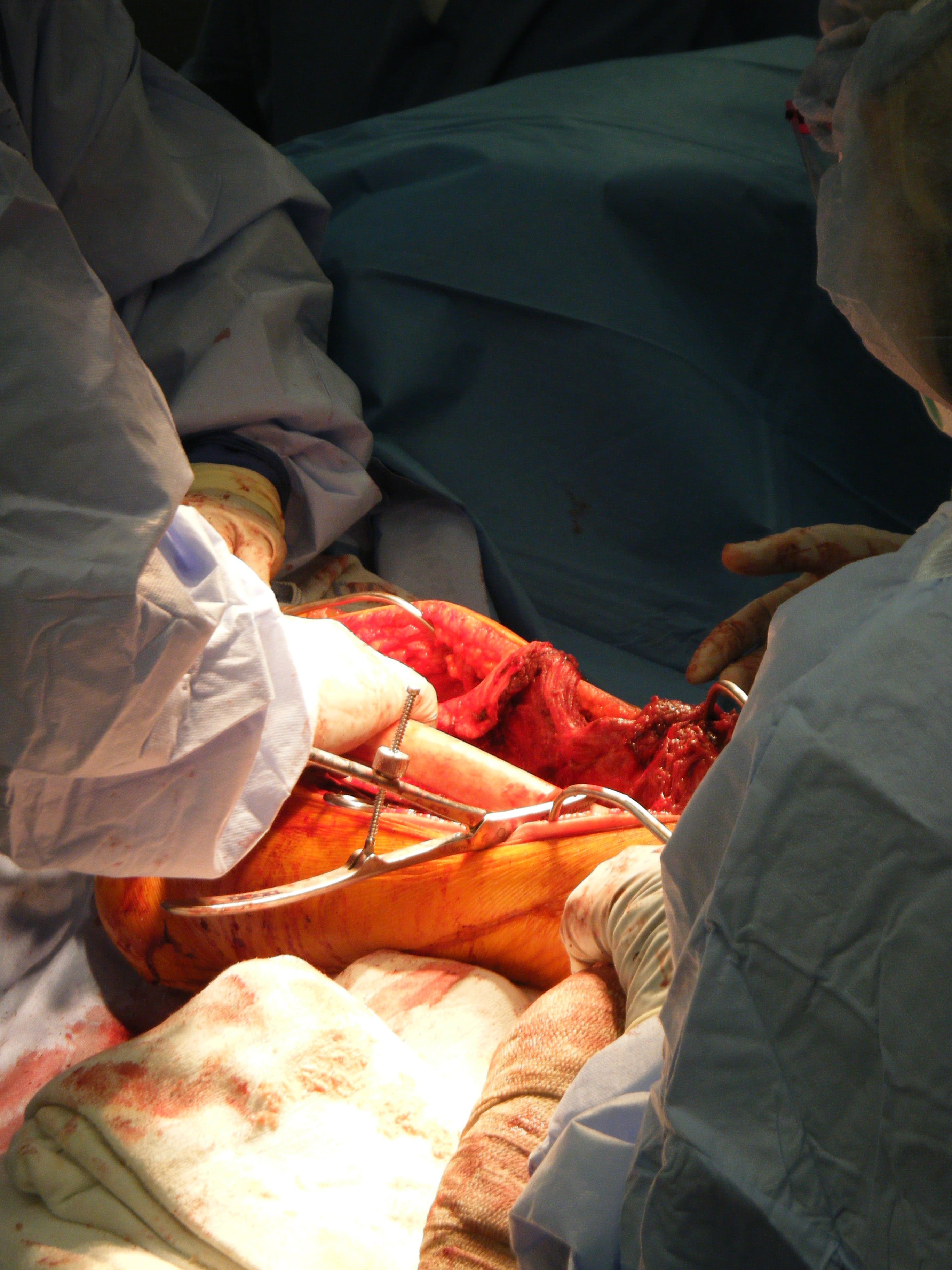 Intraoperative photograph of a large structural femoral bone allograft being positioned with a bone-holding clamp