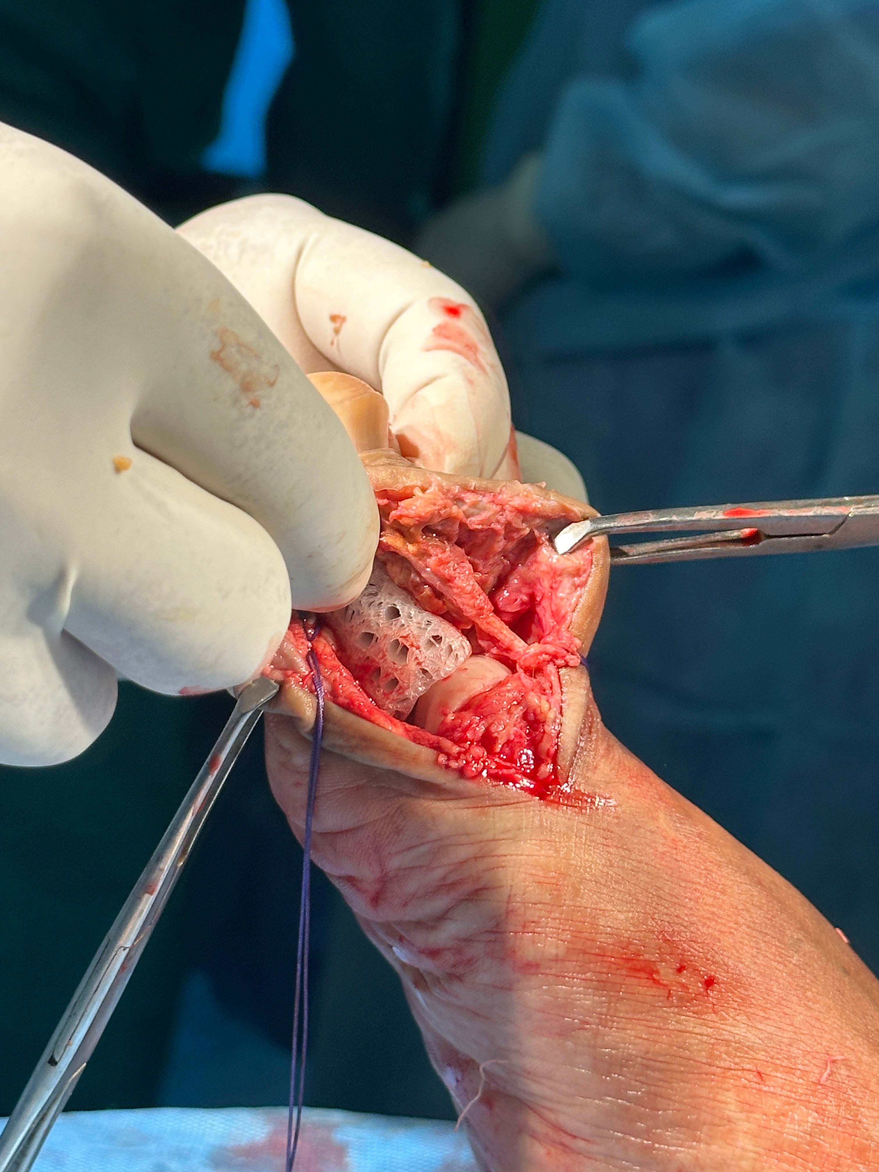 Intraoperative photograph of a porous synthetic bone scaffold being implanted into a small joint defect