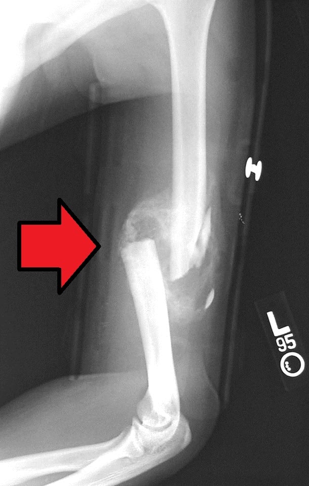Radiograph of a diaphyseal fracture healing by abundant callus.