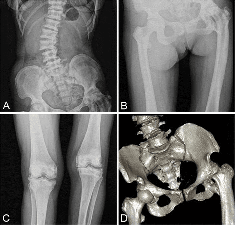 Plain radiographs of spine, pelvis and knee showing bone-within-bone appearance in the pelvis, dense bands at vertebral endplates and degenerative knee changes.
