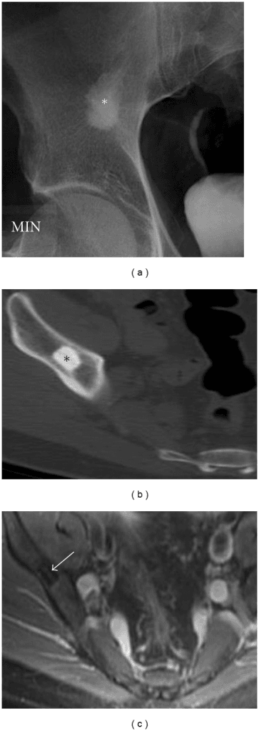 Multimodal imaging of bone island showing X-ray, CT, and MRI appearances