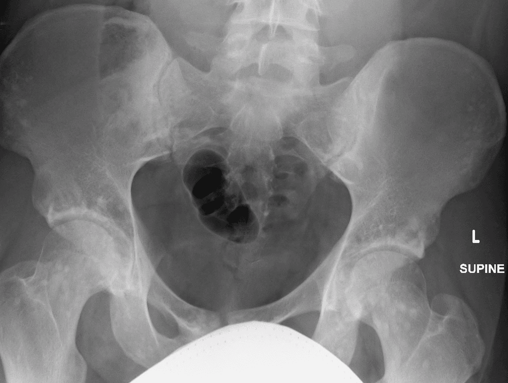 AP pelvis radiograph showing osteopoikilosis with numerous small sclerotic foci scattered bilaterally and symmetrically through the iliac bones and femoral heads