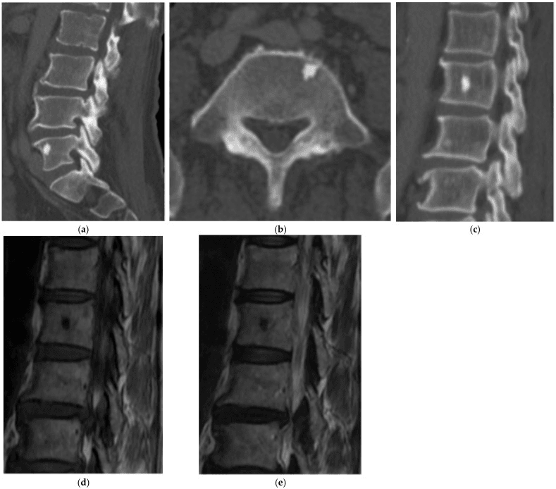 Sagittal and axial lumbar CT showing dense foci within vertebral bodies, and two sagittal MRI panels in which the lesion is a small low-signal focus