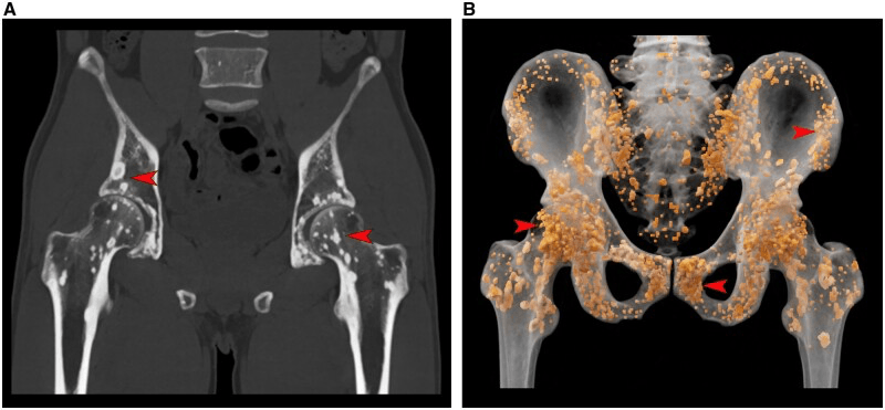 Coronal pelvic CT (A) and cinematic rendering (B) showing innumerable punctate sclerotic foci, marked by arrowheads, distributed bilaterally through the pelvis and proximal femora in osteopoikilosis