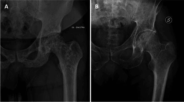 Two hip radiographs: multiple sclerotic foci of osteopoikilosis (A) beside the lytic lesions of myeloma (B)