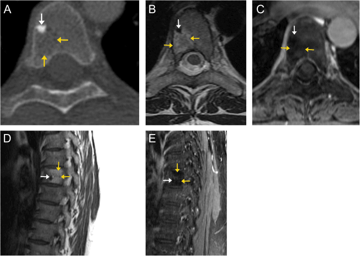 Axial CT and axial and sagittal MRI of a vertebral body: a small dense focus on CT (white arrow) that is dark on every MRI panel, with yellow arrows marking a different area of the vertebral body