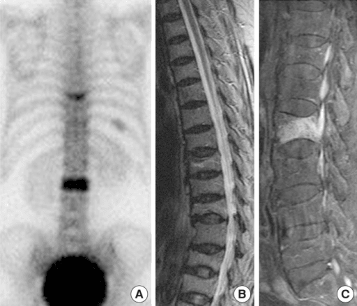 Whole-body bone scan demonstrating normal and abnormal uptake patterns