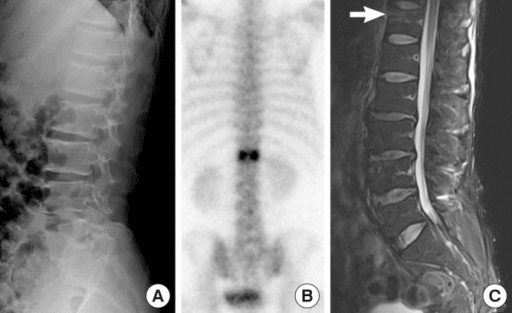 Bone scan showing focal abnormal uptake patterns requiring clinical correlation