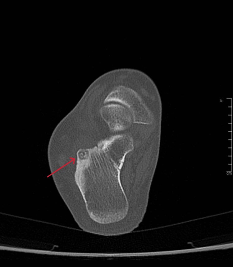 Whole-body bone scintigraphy comparing normal distribution with widespread skeletal metastases