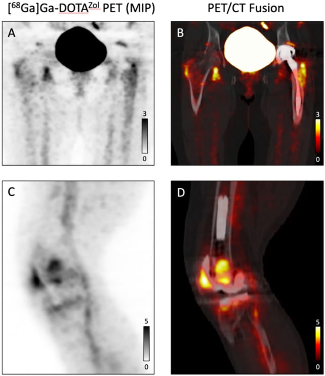 Whole-body blood pool, delayed phase and static radionuclide bone scan images