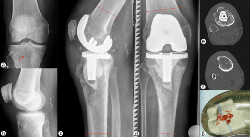 Radiographs and CT scans of a painful total knee arthroplasty evaluated for loosening