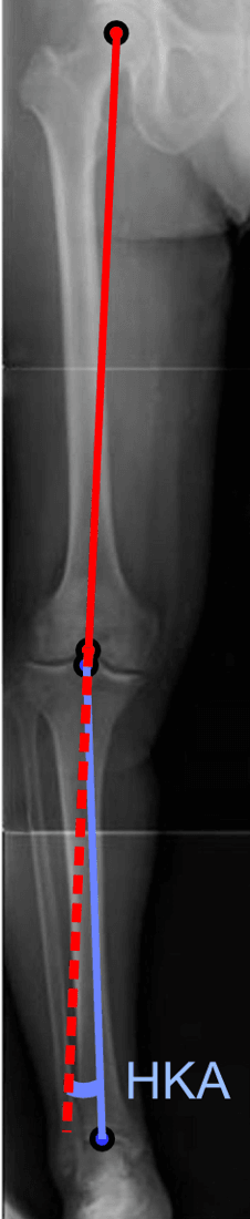 Full-length standing radiograph showing the lower-limb mechanical axis and hip-knee-ankle angle