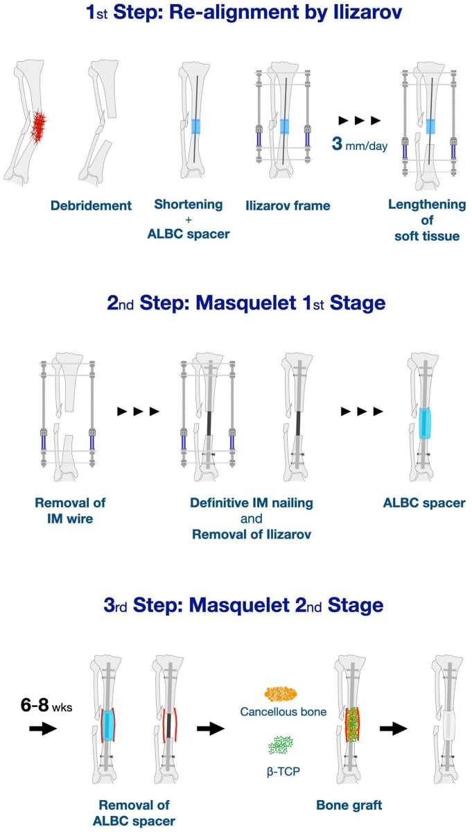 Three-stage schematic combining Ilizarov realignment and lengthening with first- and second-stage Masquelet reconstruction.
