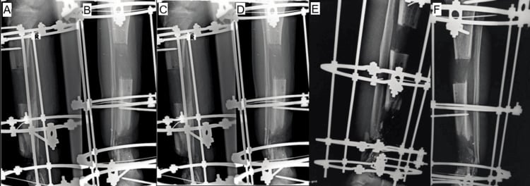 Six serial tibial radiographs showing progressive distraction osteogenesis in an Ilizarov circular frame.